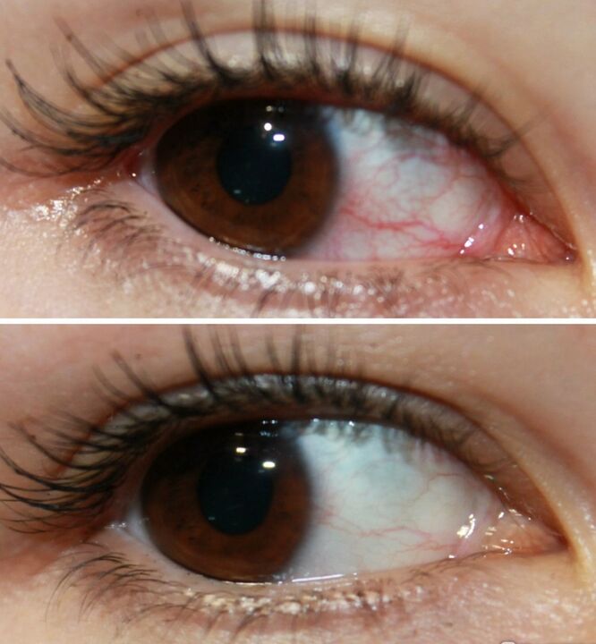 Ocuvit rīkojas ļoti ātri